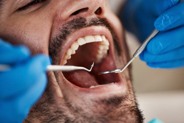 Emergency Dental Filling Replacement in CT